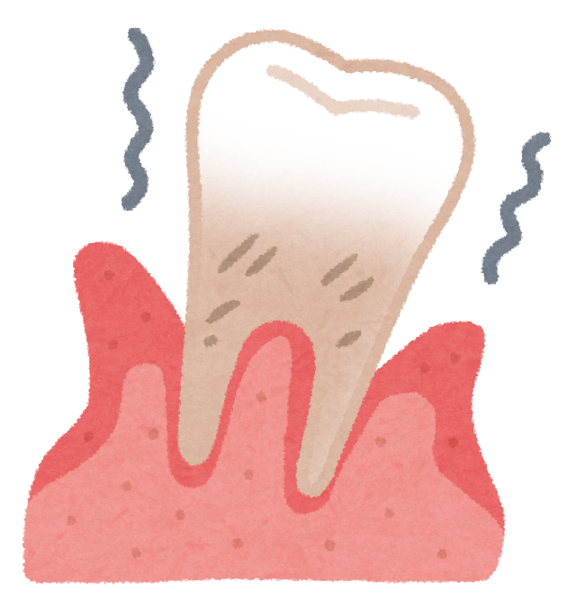 歯周病と生活習慣について