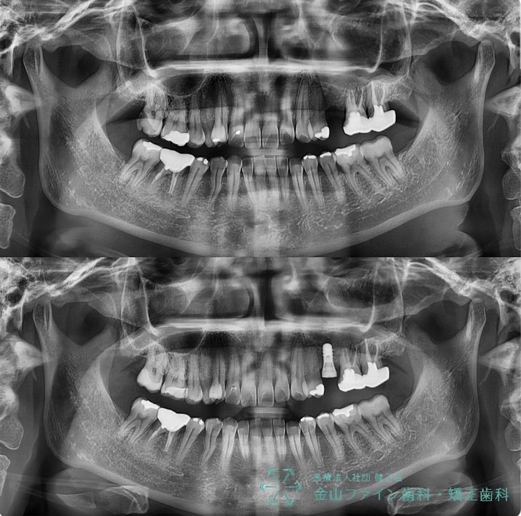 歯の欠損について