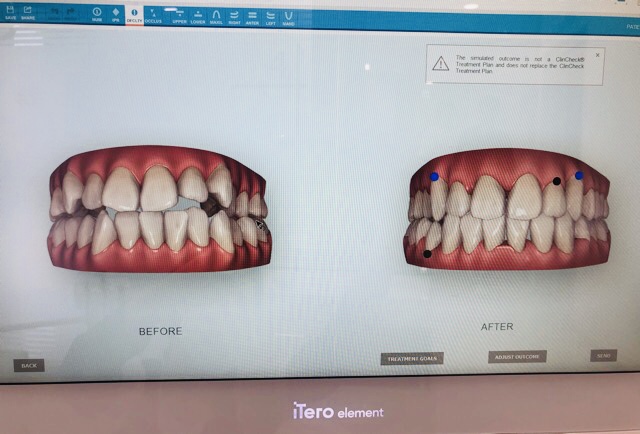 口腔内3Dスキャナー『iTero (アイテロ)』について