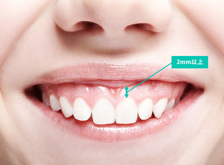 笑顔のとき、あなたの歯茎はどれくらい見えていますか？